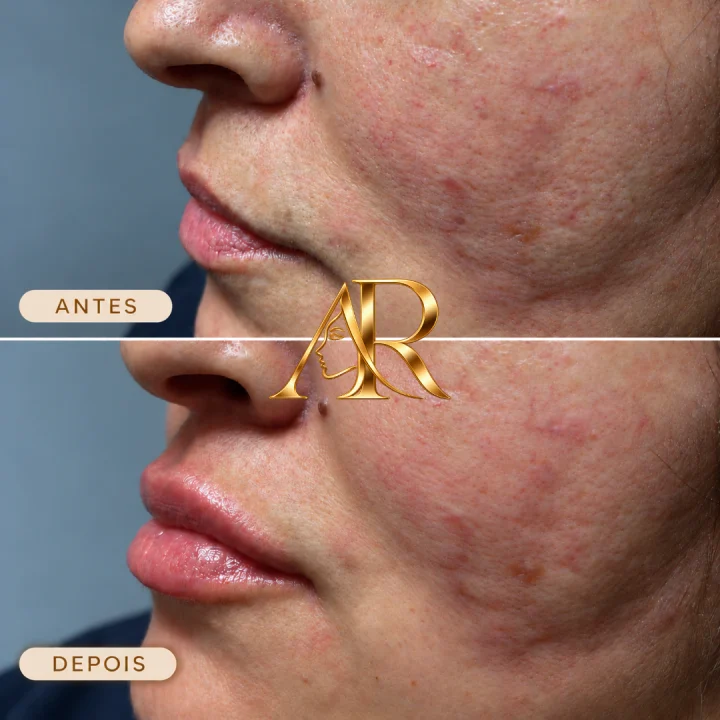 Resultado real 2 de 5: antes e depois de procedimento realizado pela Dra. Andrieli Rossa